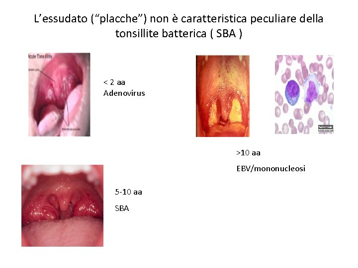 L’essudato (“placche”) non è caratteristica peculiare della tonsillite batterica ( SBA ) < 2