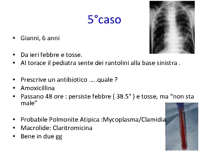 5°caso • Gianni, 6 anni • Da ieri febbre e tosse. • Al torace