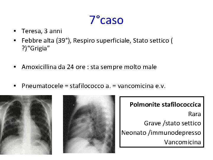 7°caso • Teresa, 3 anni • Febbre alta (39°), Respiro superficiale, Stato settico (