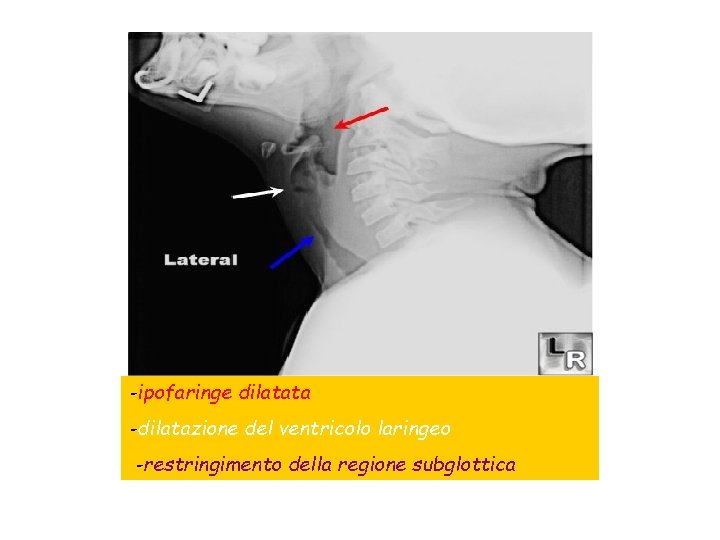 -ipofaringe dilatata -dilatazione del ventricolo laringeo -restringimento della regione subglottica 