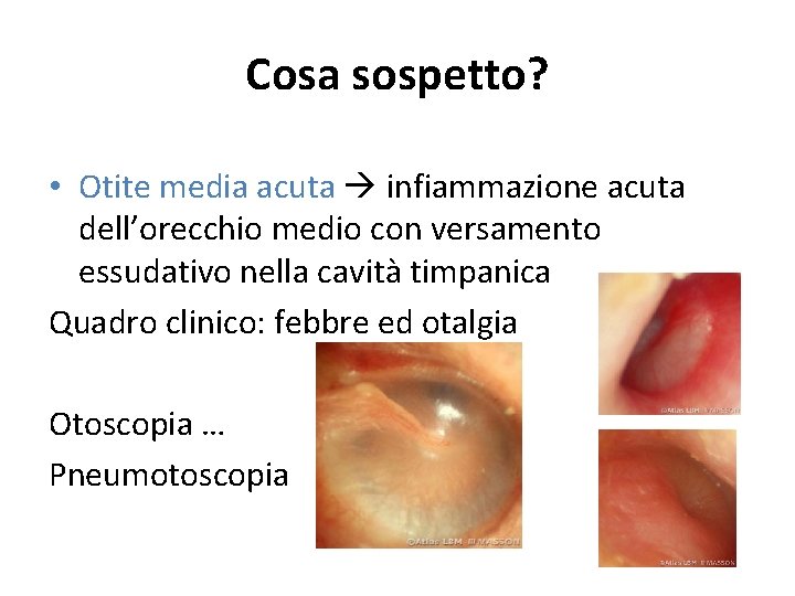 Cosa sospetto? • Otite media acuta infiammazione acuta dell’orecchio medio con versamento essudativo nella