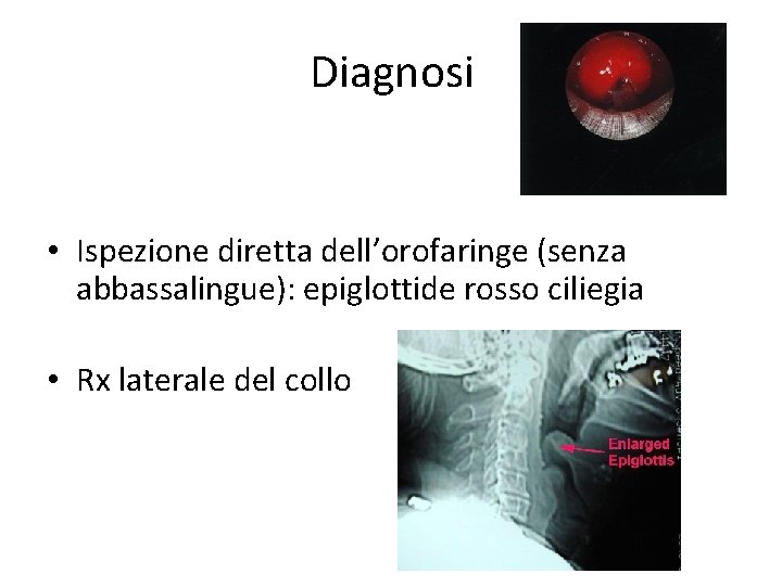 Diagnosi • Ispezione diretta dell’orofaringe (senza abbassalingue): epiglottide rosso ciliegia • Rx laterale del