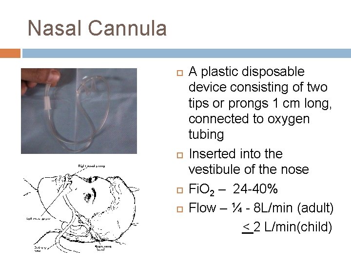 Nasal Cannula A plastic disposable device consisting of two tips or prongs 1 cm