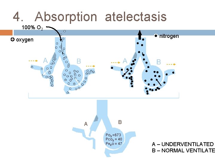 4. Absorption atelectasis 100% O 2 nitrogen oxygen A B PO 2 =673 PCO