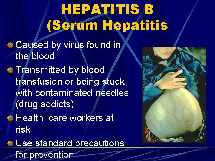 HEPATITIS B (Serum Hepatitis Caused by virus found in the blood Transmitted by blood