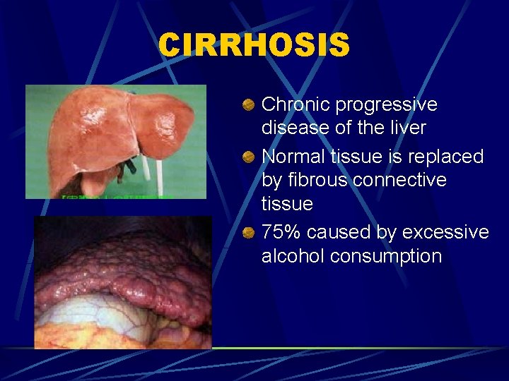 CIRRHOSIS Chronic progressive disease of the liver Normal tissue is replaced by fibrous connective
