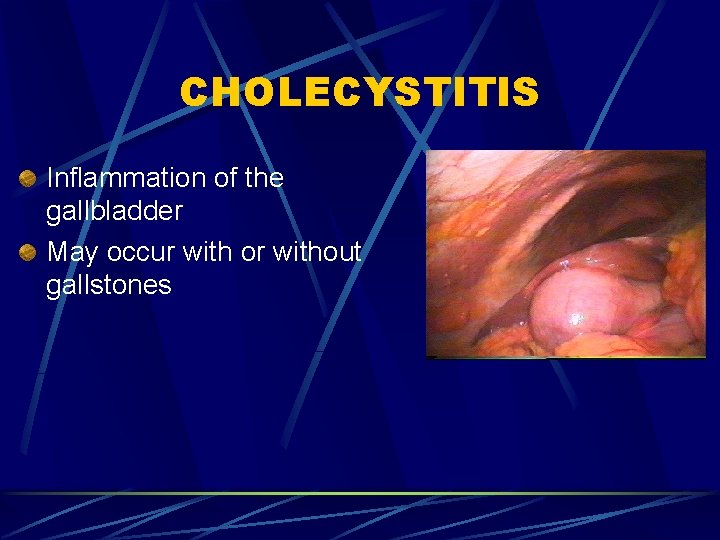 CHOLECYSTITIS Inflammation of the gallbladder May occur with or without gallstones 