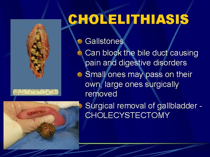 CHOLELITHIASIS Gallstones Can block the bile duct causing pain and digestive disorders Small ones