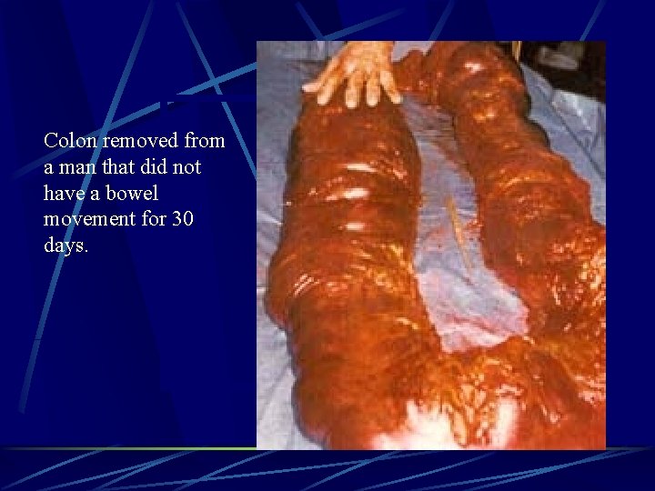 Colon removed from a man that did not have a bowel movement for 30