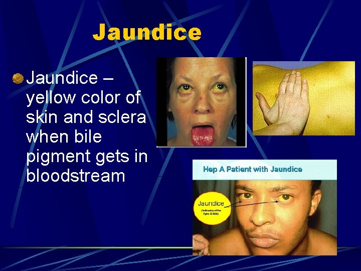 Jaundice – yellow color of skin and sclera when bile pigment gets in bloodstream