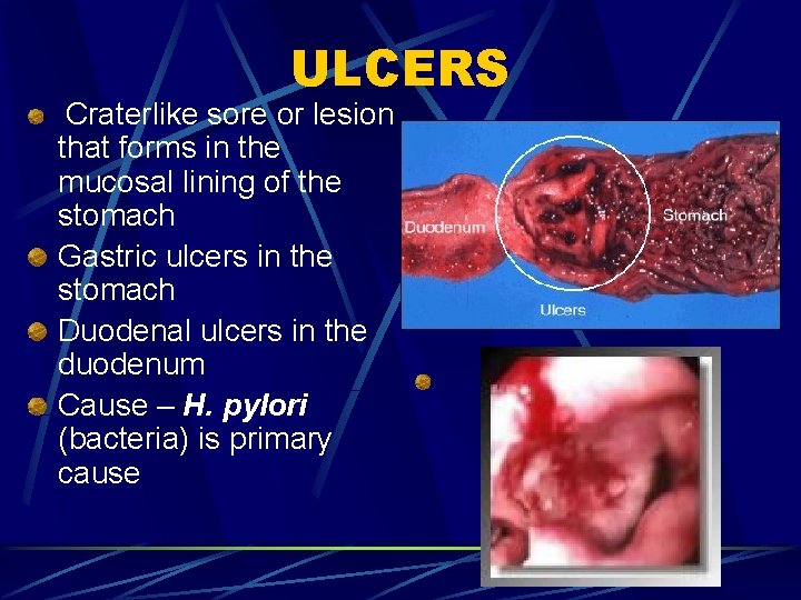 ULCERS Craterlike sore or lesion that forms in the mucosal lining of the stomach