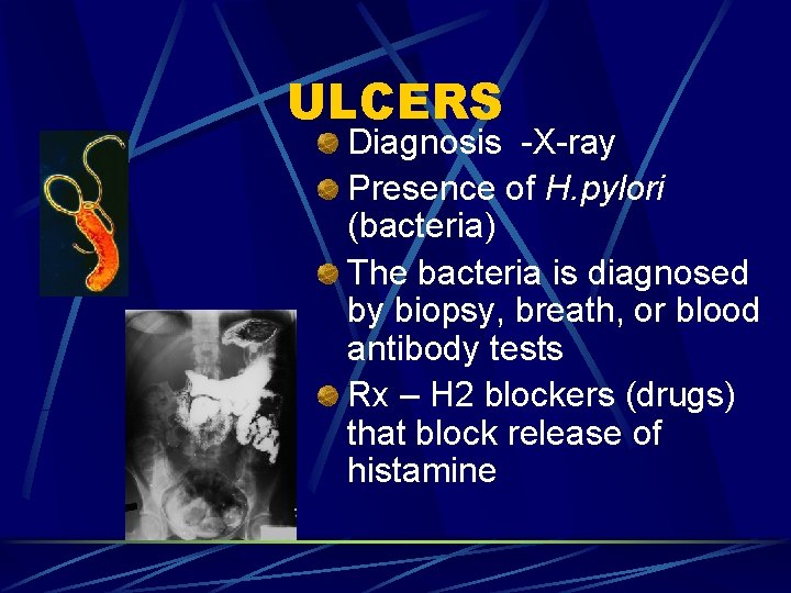 ULCERS Diagnosis -X-ray Presence of H. pylori (bacteria) The bacteria is diagnosed by biopsy,