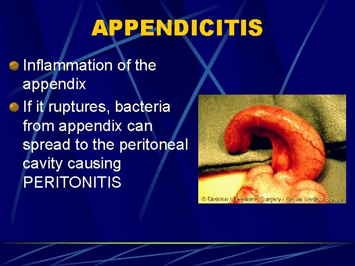 APPENDICITIS Inflammation of the appendix If it ruptures, bacteria from appendix can spread to