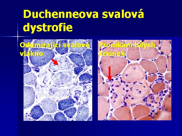 Duchenneova svalová dystrofie Odumírající svalové vlákno Pronikání bílých krvinek 
