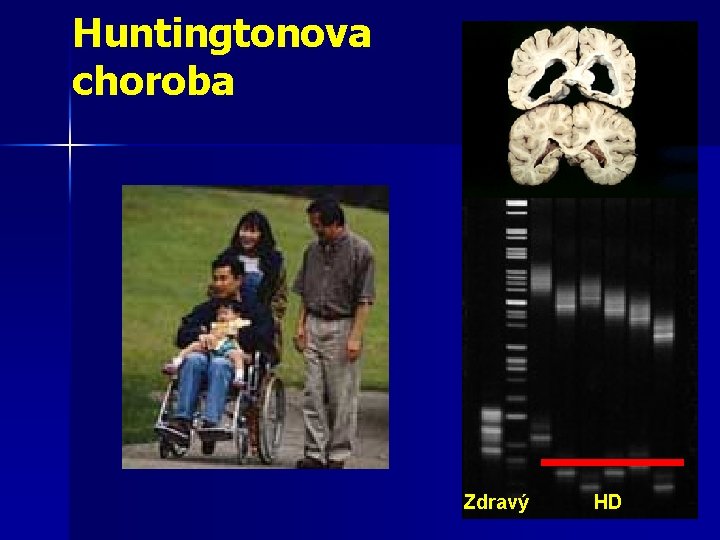 Huntingtonova choroba Zdravý HD 