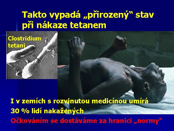 Takto vypadá „přirozený“ stav při nákaze tetanem Clostridium tetani I v zemích s rozvinutou