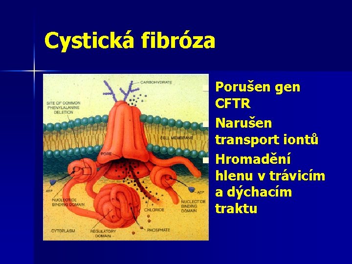 Cystická fibróza n n n Porušen gen CFTR Narušen transport iontů Hromadění hlenu v