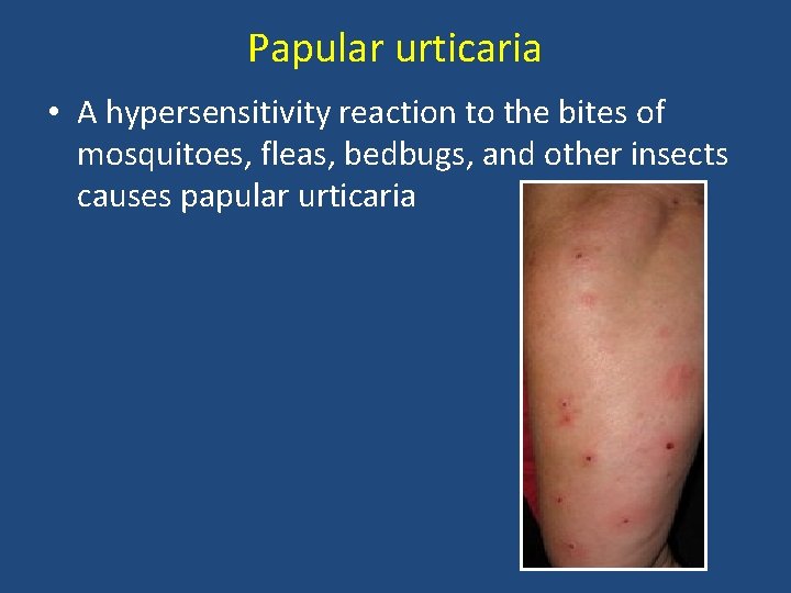 Papular urticaria • A hypersensitivity reaction to the bites of mosquitoes, fleas, bedbugs, and Papular urticaria • A hypersensitivity reaction to the bites of mosquitoes, fleas, bedbugs, and