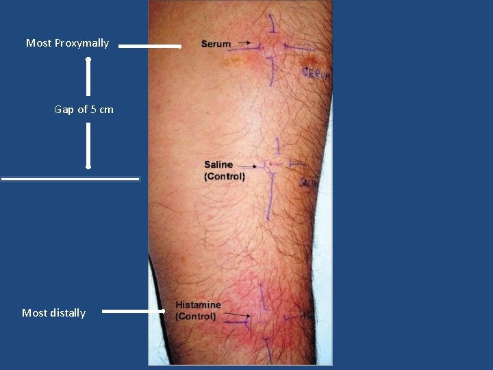 Most Proxymally Gap of 5 cm Most distally Most Proxymally Gap of 5 cm Most distally