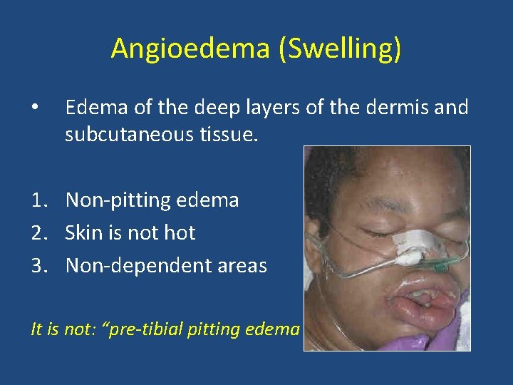 Angioedema (Swelling) • Edema of the deep layers of the dermis and subcutaneous tissue. Angioedema (Swelling) • Edema of the deep layers of the dermis and subcutaneous tissue.