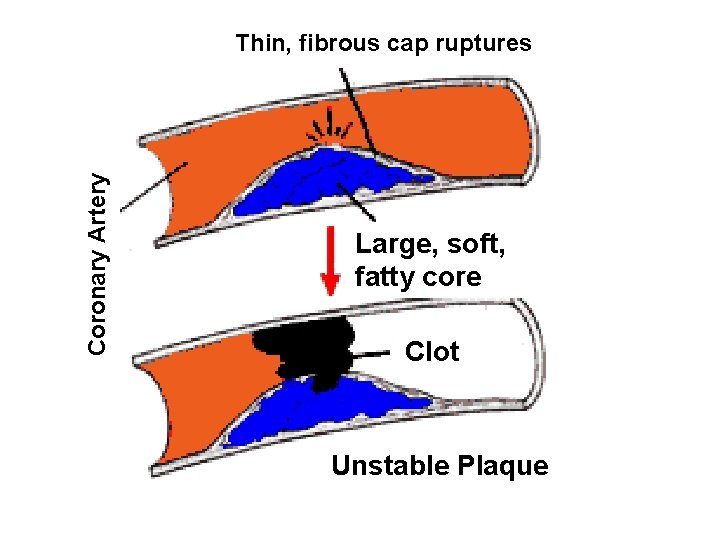 Coronary Artery Thin, fibrous cap ruptures Large, soft, fatty core Clot Unstable Plaque 