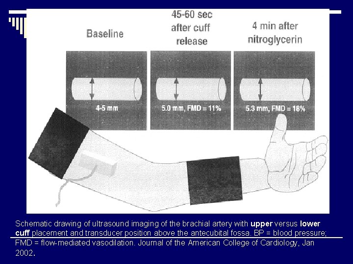 Schematic drawing of ultrasound imaging of the brachial artery with upper versus lower cuff