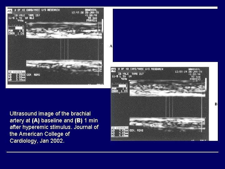 Ultrasound image of the brachial artery at (A) baseline and (B) 1 min after