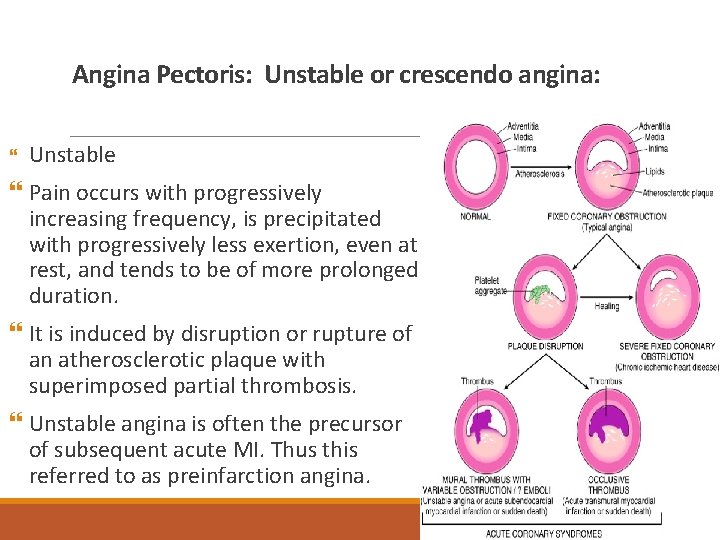 Angina Pectoris: Unstable or crescendo angina: Unstable Pain occurs with progressively increasing frequency, is