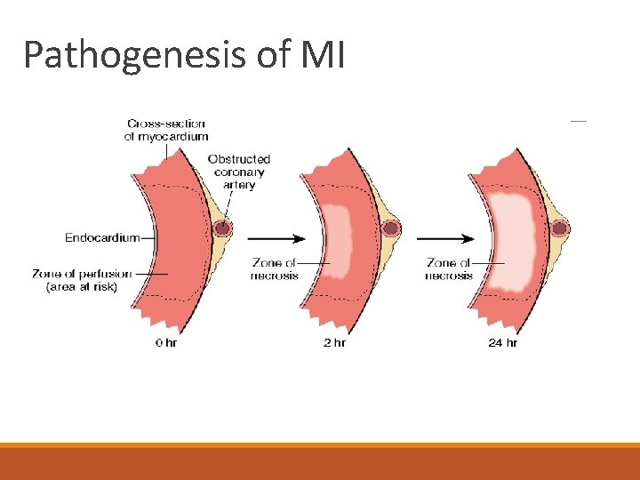 Pathogenesis of MI 