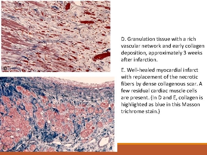 D. Granulation tissue with a rich vascular network and early collagen deposition, approximately 3