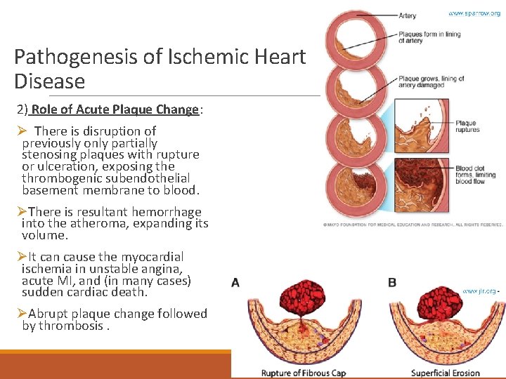 Pathogenesis of Ischemic Heart Disease 2) Role of Acute Plaque Change: Ø There is