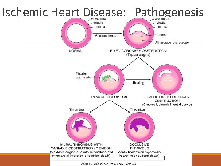 Ischemic Heart Disease: Pathogenesis 