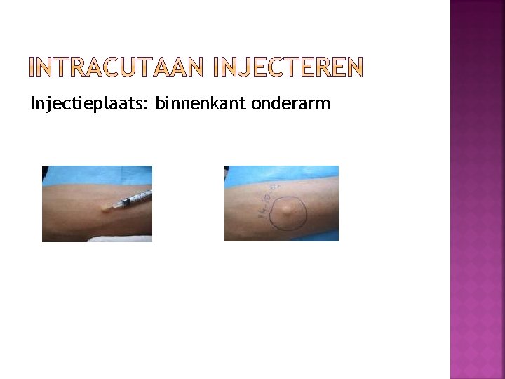 Injectieplaats: binnenkant onderarm 