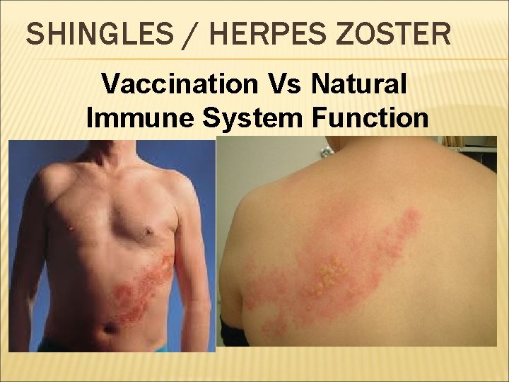 SHINGLES / HERPES ZOSTER Vaccination Vs Natural Immune System Function 