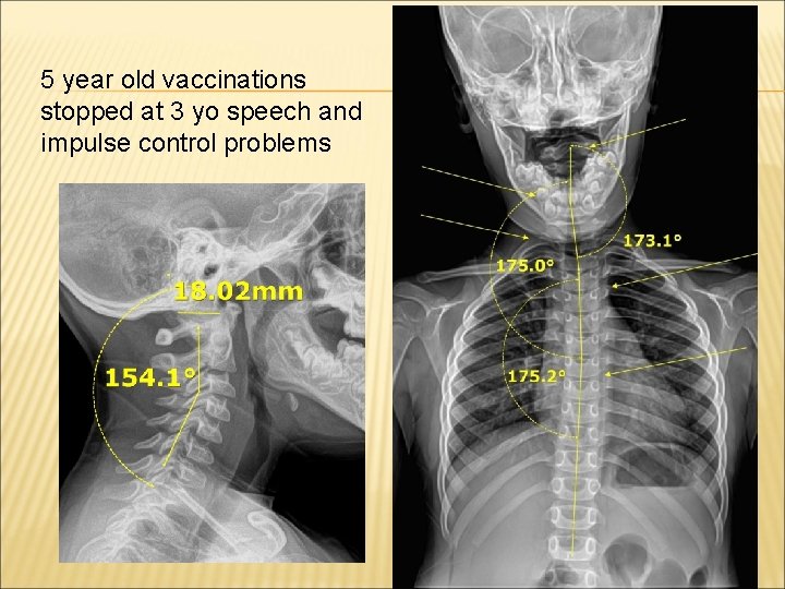 5 year old vaccinations stopped at 3 yo speech and impulse control problems 