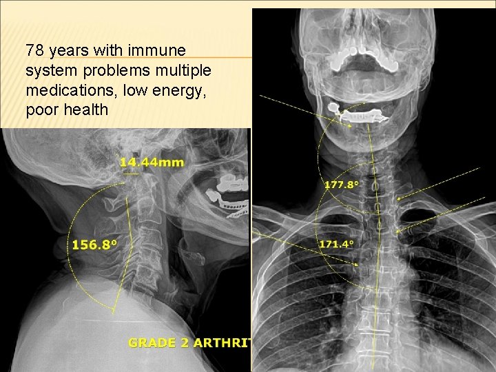 78 years with immune system problems multiple medications, low energy, poor health 