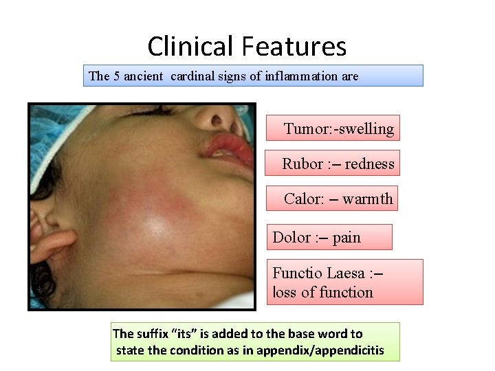 Clinical Features The 5 ancient cardinal signs of inflammation are Tumor: -swelling Rubor :
