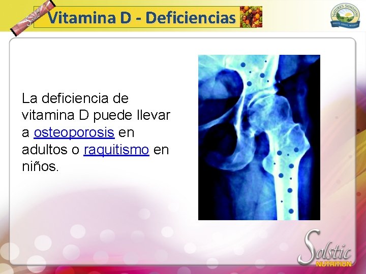 Vitamina D - Deficiencias La deficiencia de vitamina D puede llevar a osteoporosis en