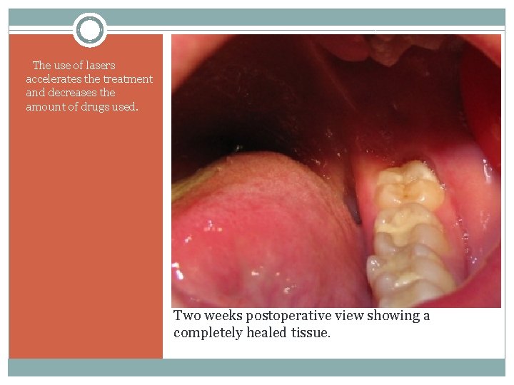 The use of lasers accelerates the treatment and decreases the amount of drugs used.