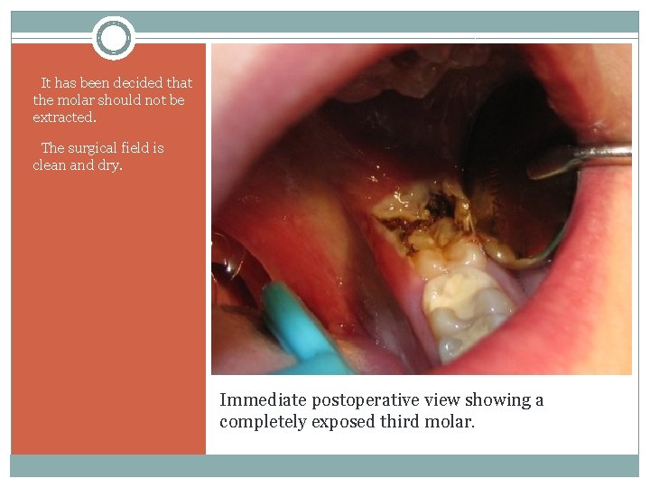It has been decided that the molar should not be extracted. The surgical field