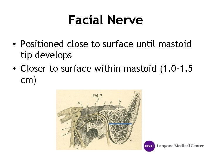 Facial Nerve • Positioned close to surface until mastoid tip develops • Closer to