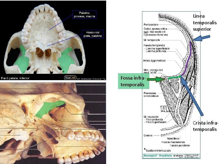 Linea temporalis superior Fossa infratemporalis Crista infratemporalis 