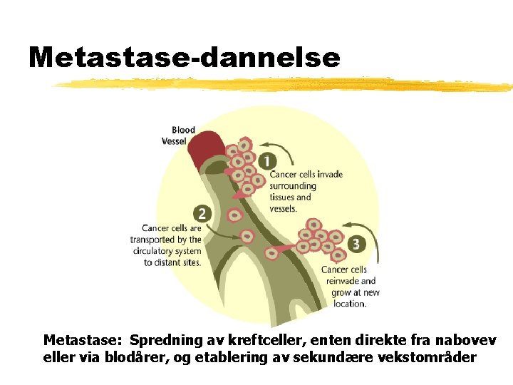 Metastase-dannelse Metastase: Spredning av kreftceller, enten direkte fra nabovev eller via blodårer, og etablering Metastase-dannelse Metastase: Spredning av kreftceller, enten direkte fra nabovev eller via blodårer, og etablering