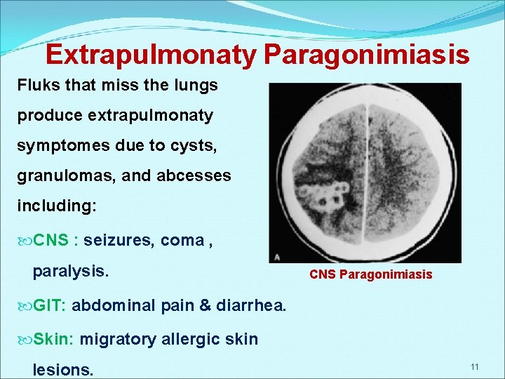Extrapulmonaty Paragonimiasis Fluks that miss the lungs produce extrapulmonaty symptomes due to cysts, granulomas,