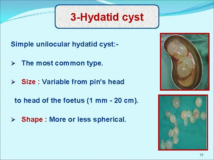 3 -Hydatid cyst Simple unilocular hydatid cyst: Ø The most common type. Ø Size