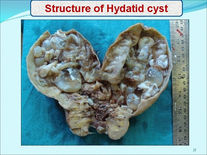 Structure of Hydatid cyst 21 