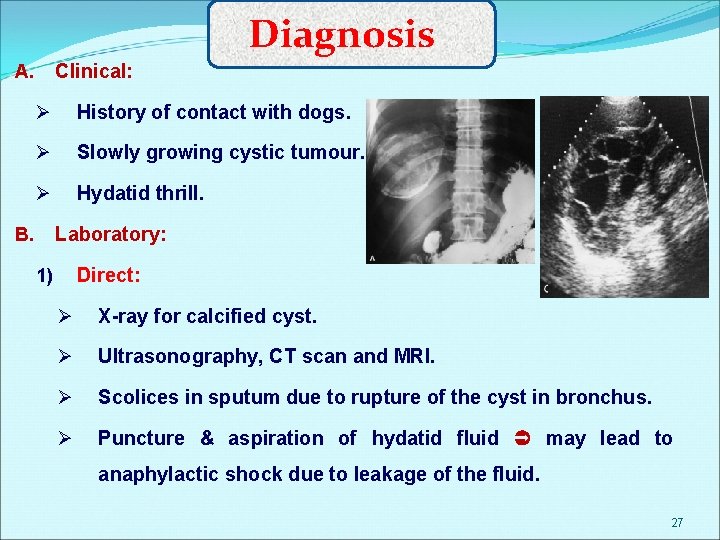 Diagnosis Clinical: A. Ø History of contact with dogs. Ø Slowly growing cystic tumour.