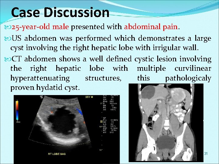 Case Discussion 25 -year-old male presented with abdominal pain. US abdomen was performed which