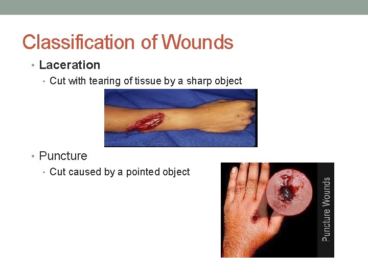 Classification of Wounds • Laceration • Cut with tearing of tissue by a sharp