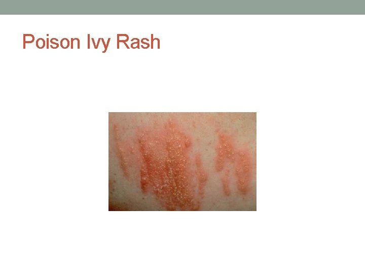 Poison Ivy Rash 